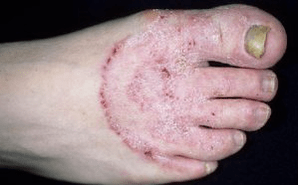 Le ragioni dell'apparizione del fungo sulle gambe