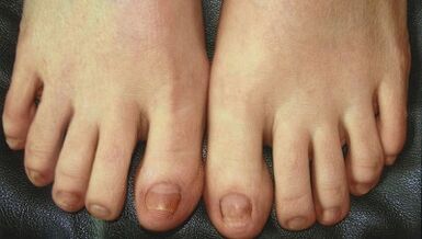 Fase di sviluppo del fungo delle unghie