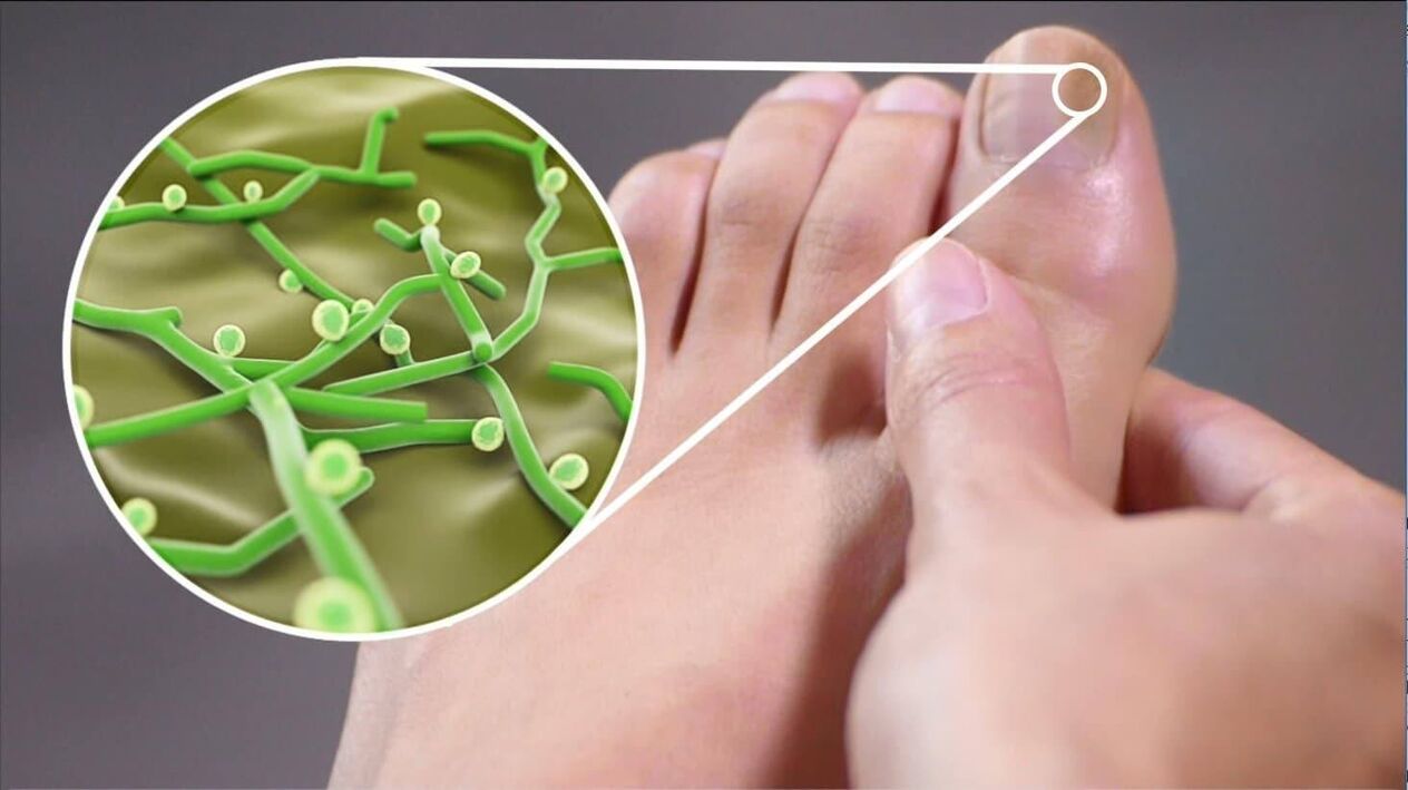 agenti patogeni del fungo dell'unghia del piede