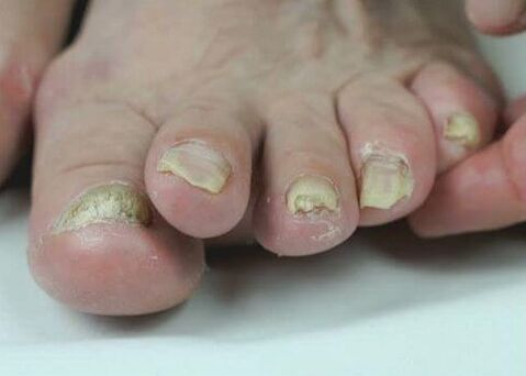 trattamento dei funghi delle unghie con farmaci