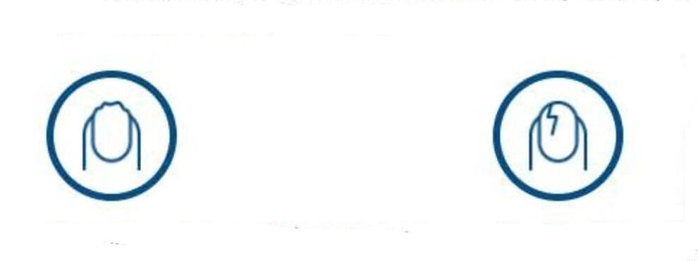 deformazione delle unghie dovuta a infezione fungina