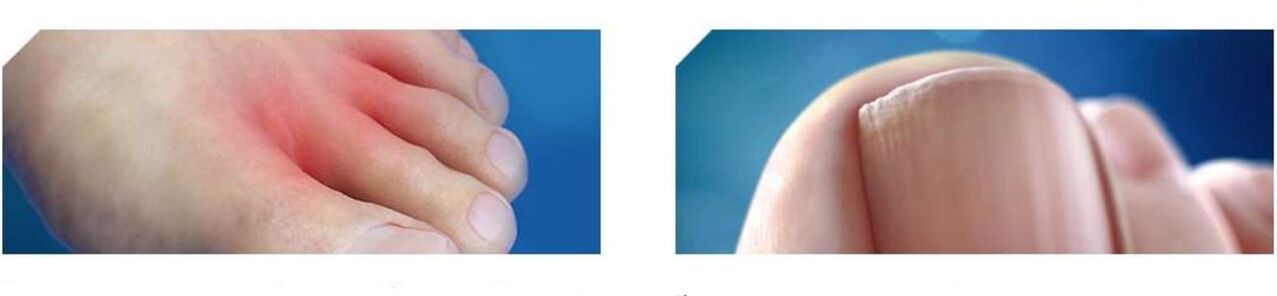 stadio iniziale del fungo del piede